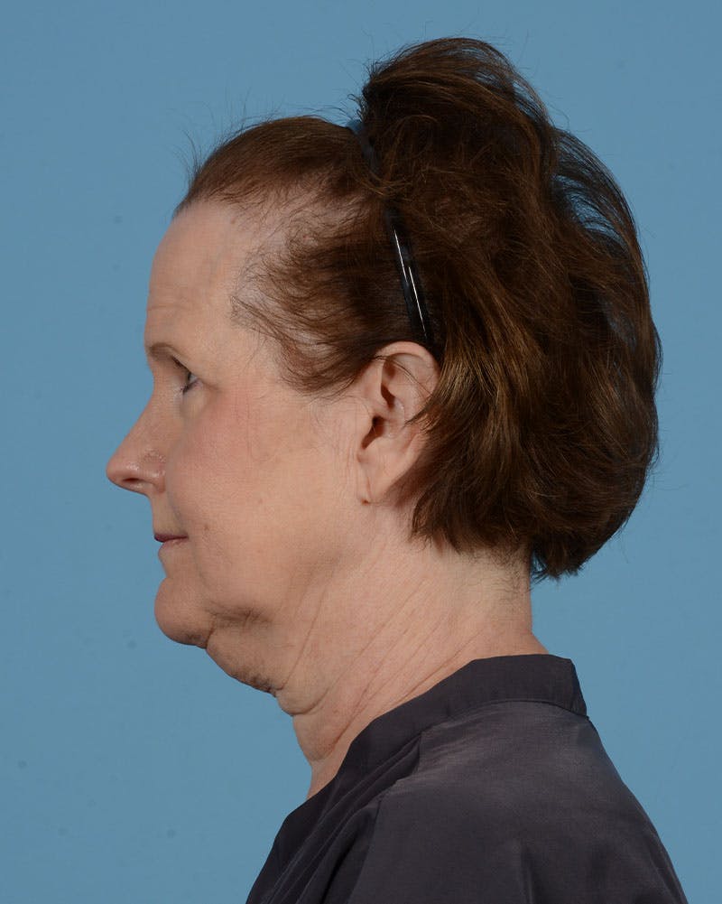 Neck Lift Before & After Gallery - Patient 39182691 - Image 7