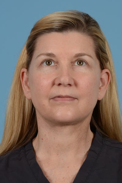 Facelift Before & After Gallery - Patient 52535486 - Image 6
