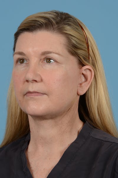 Neck Lift Before & After Gallery - Patient 52535501 - Image 8