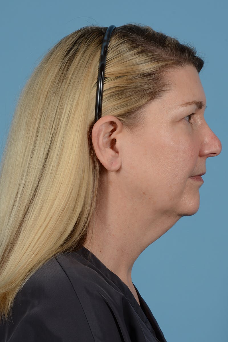 Neck Lift Before & After Gallery - Patient 52535501 - Image 9