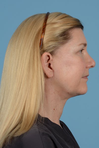 Facelift Before & After Gallery - Patient 52535486 - Image 10