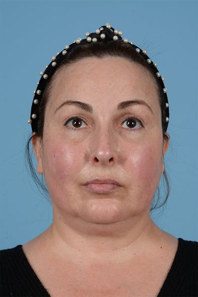 Facelift Before & After Gallery - Patient 52643815 - Image 1