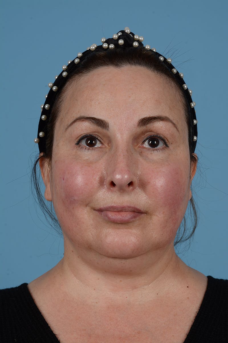 Brow Lift Before & After Gallery - Patient 52643792 - Image 3