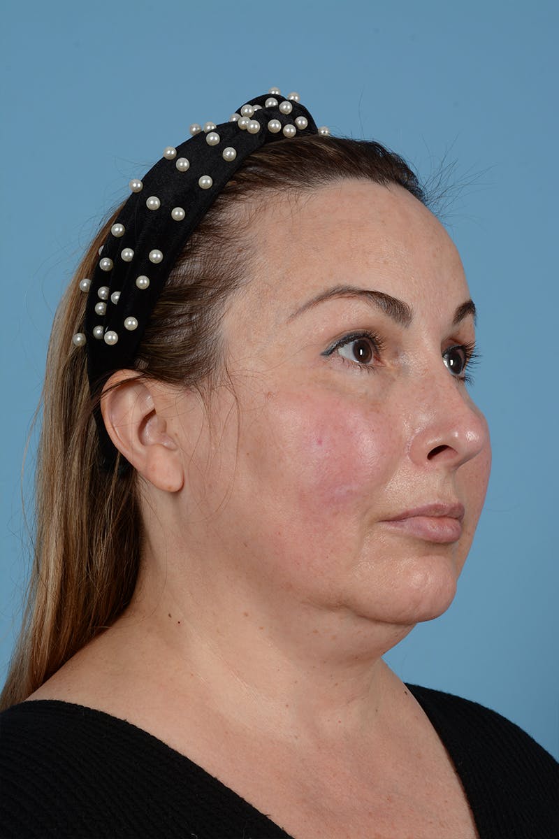 Skin Resurfacing Before & After Gallery - Patient 52643893 - Image 5
