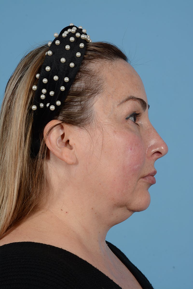 Facelift Before & After Gallery - Patient 52643815 - Image 7