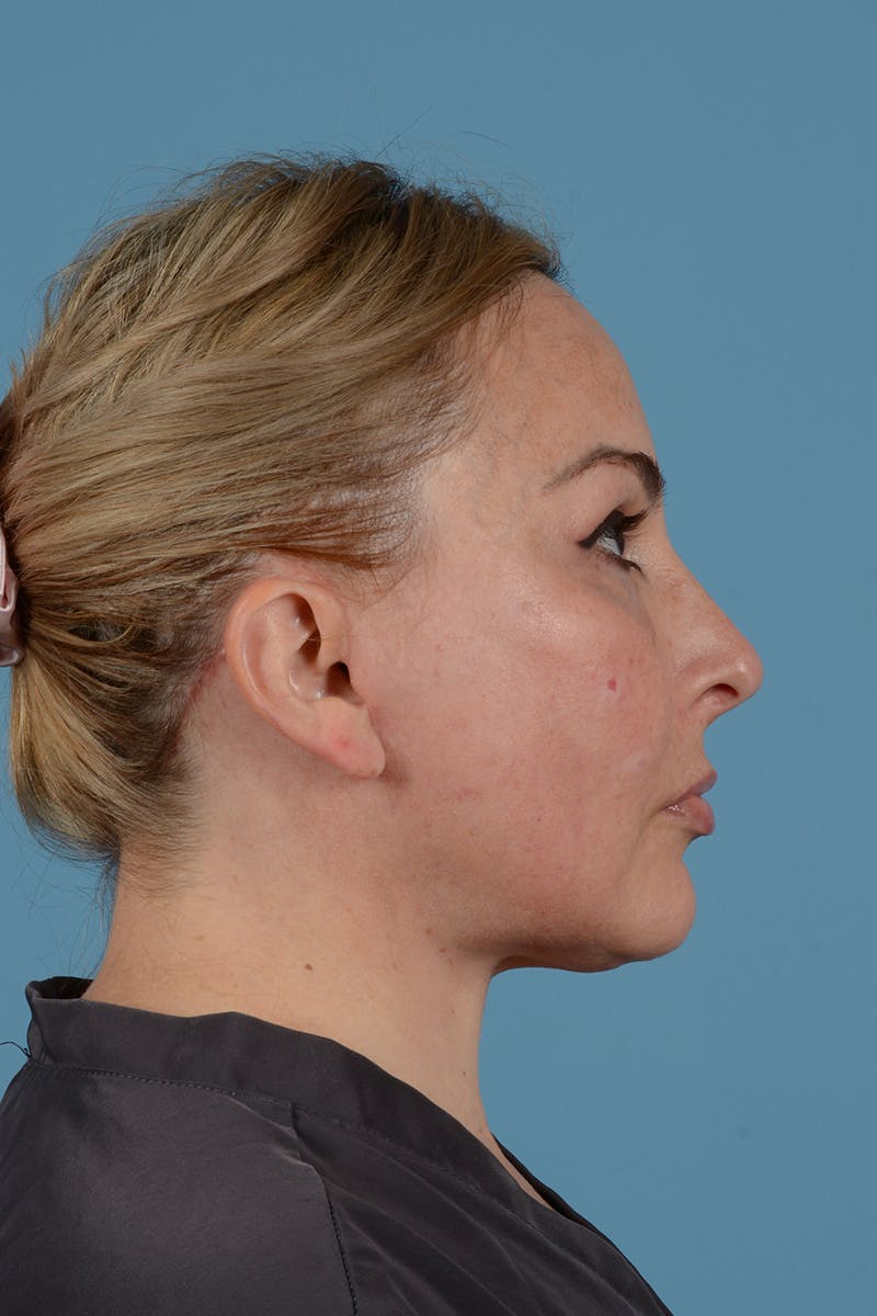 Skin Resurfacing Before & After Gallery - Patient 52643893 - Image 8