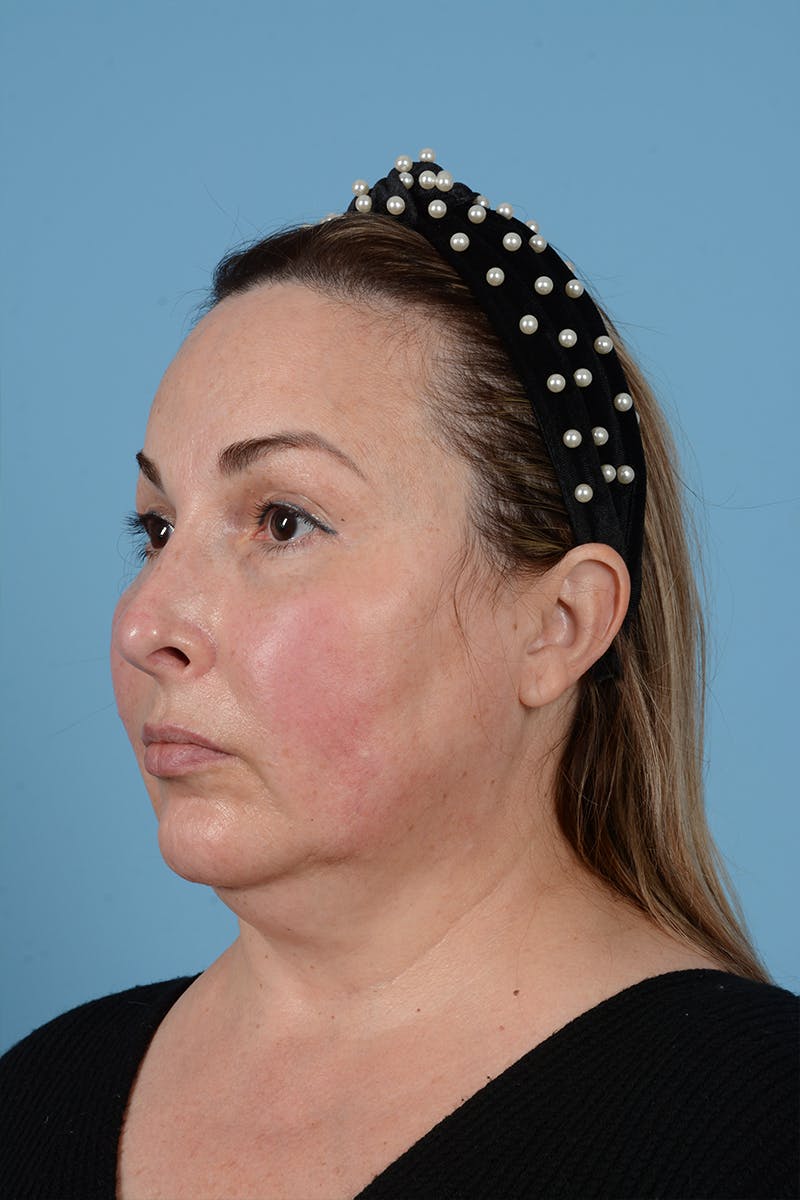 Brow Lift Before & After Gallery - Patient 52643792 - Image 9