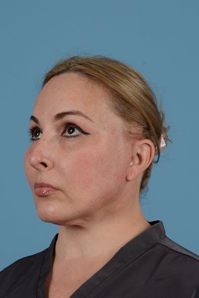 Brow Lift Before & After Gallery - Patient 52643792 - Image 10