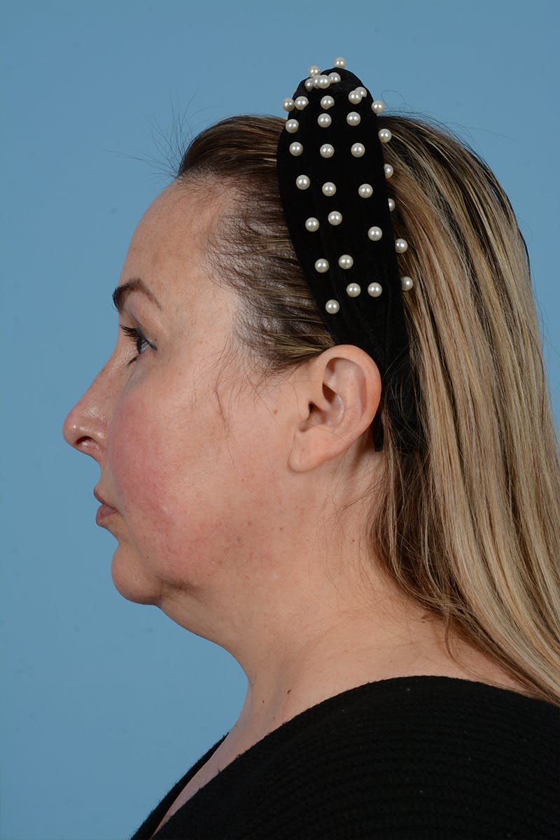 Brow Lift Before & After Gallery - Patient 52643792 - Image 11