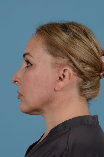 Brow Lift Before & After Gallery - Patient 52643792 - Image 12