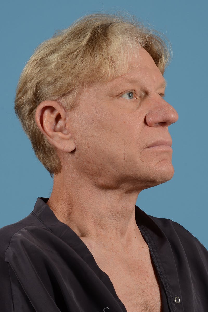 Facelift Before & After Gallery - Patient 52644013 - Image 4