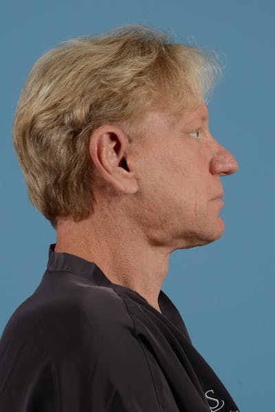 Facelift Before & After Gallery - Patient 52644013 - Image 6
