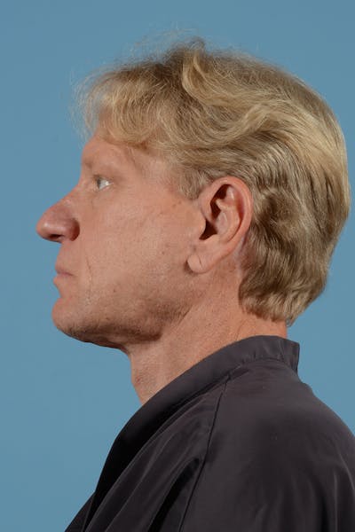 Neck Lift Before & After Gallery - Patient 52644082 - Image 10