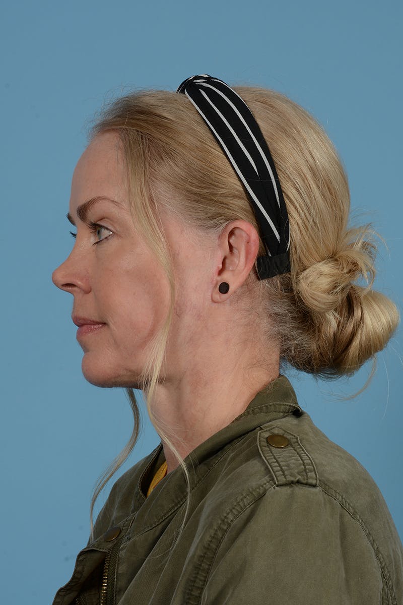 Neck Lift Before & After Gallery - Patient 52644215 - Image 12
