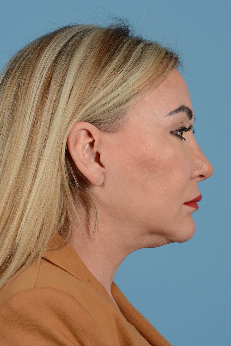 Neck Lift Before & After Gallery - Patient 52644393 - Image 2
