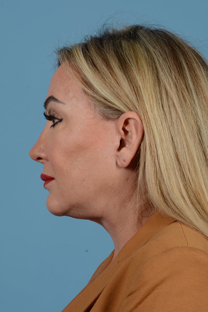 Facelift Before & After Gallery - Patient 52644392 - Image 4