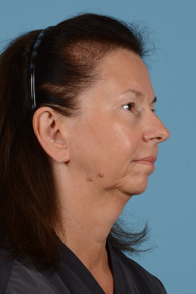 Neck Lift Before & After Gallery - Patient 72509469 - Image 9