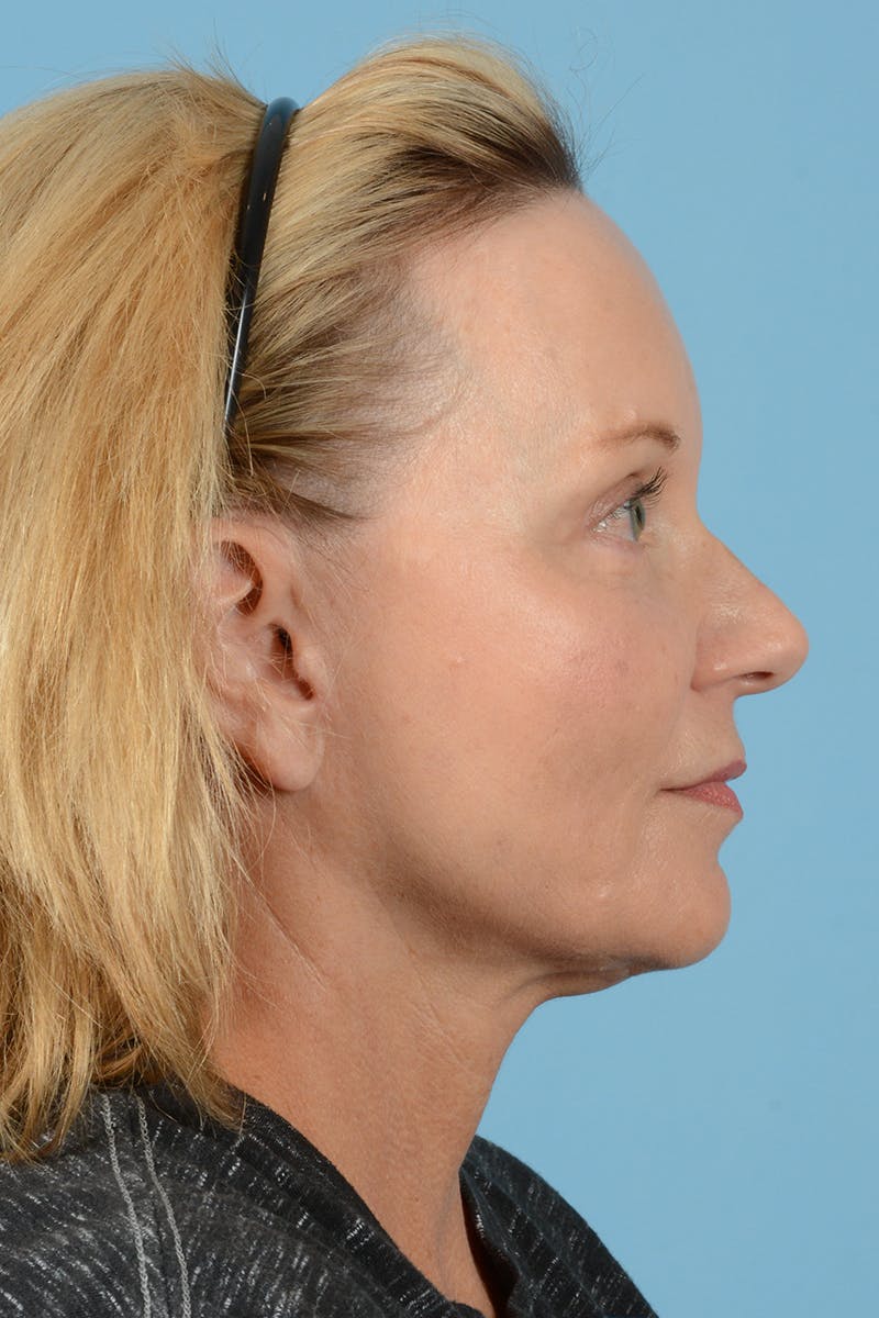 Brow Lift Before & After Gallery - Patient 72510182 - Image 6