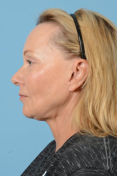 Neck Lift Before & After Gallery - Patient 72510187 - Image 10