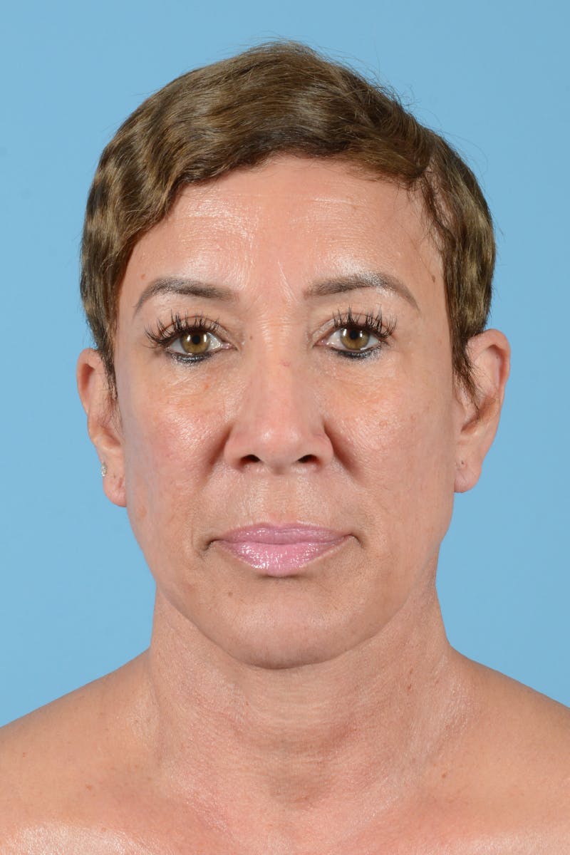 Facelift Before & After Gallery - Patient 72510211 - Image 2