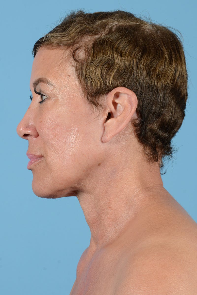 Facelift Before & After Gallery - Patient 72510211 - Image 12