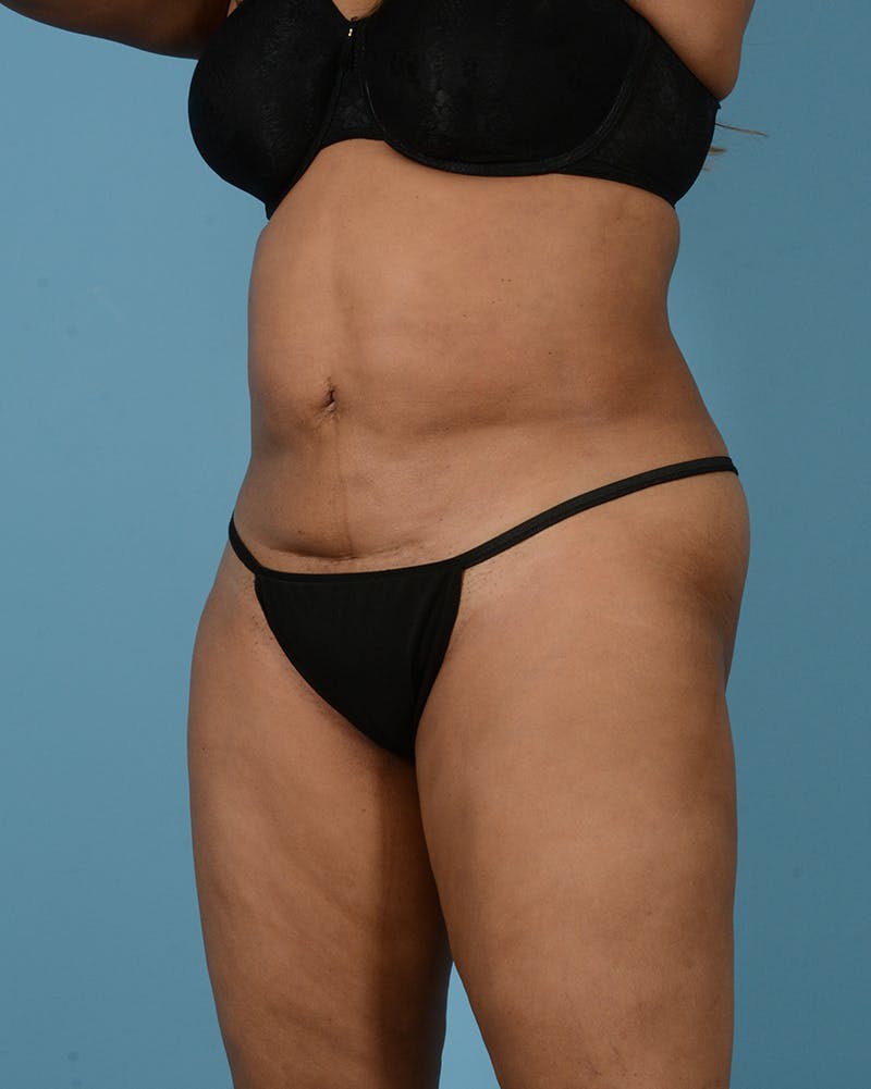 Tummy Tuck Before & After Gallery - Patient 113328002 - Image 3