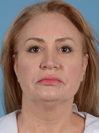 Facelift Before & After Gallery - Patient 113328021 - Image 1