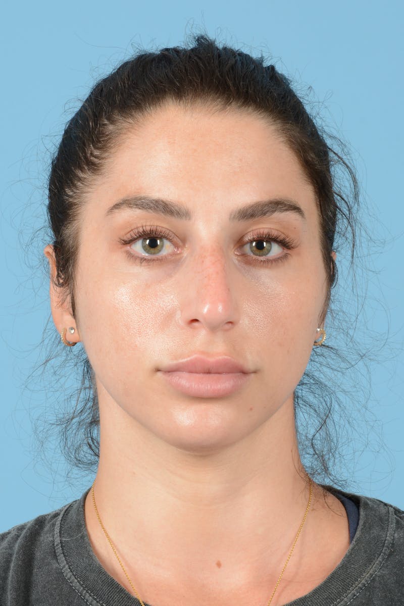 Rhinoplasty Before & After Gallery - Patient 113491186 - Image 3