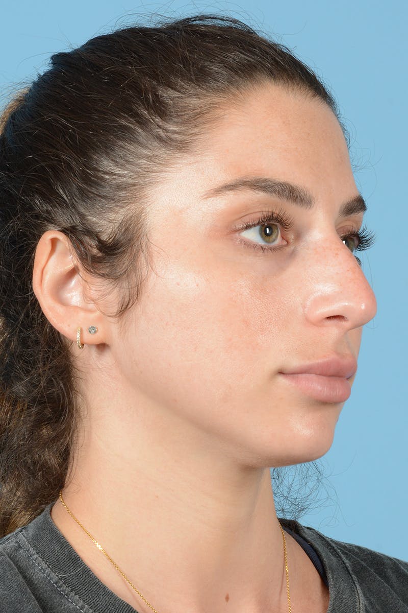 Rhinoplasty Before & After Gallery - Patient 113491186 - Image 7