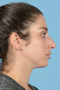 Rhinoplasty Before & After Gallery - Patient 113491186 - Image 1