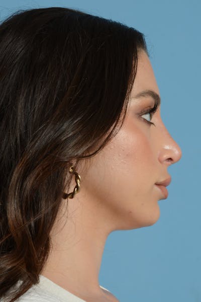 Rhinoplasty Before & After Gallery - Patient 113491186 - Image 2