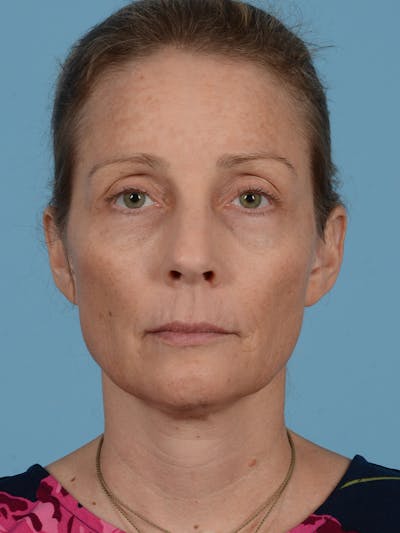 Facelift Before & After Gallery - Patient 113492995 - Image 1