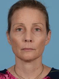 Facelift Before & After Gallery - Patient 113492995 - Image 1