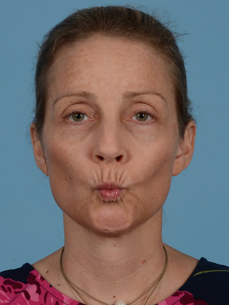 Neck Lift Before & After Gallery - Patient 113492988 - Image 3