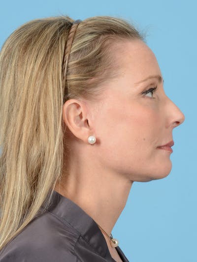 Neck Lift Before & After Gallery - Patient 113492988 - Image 8