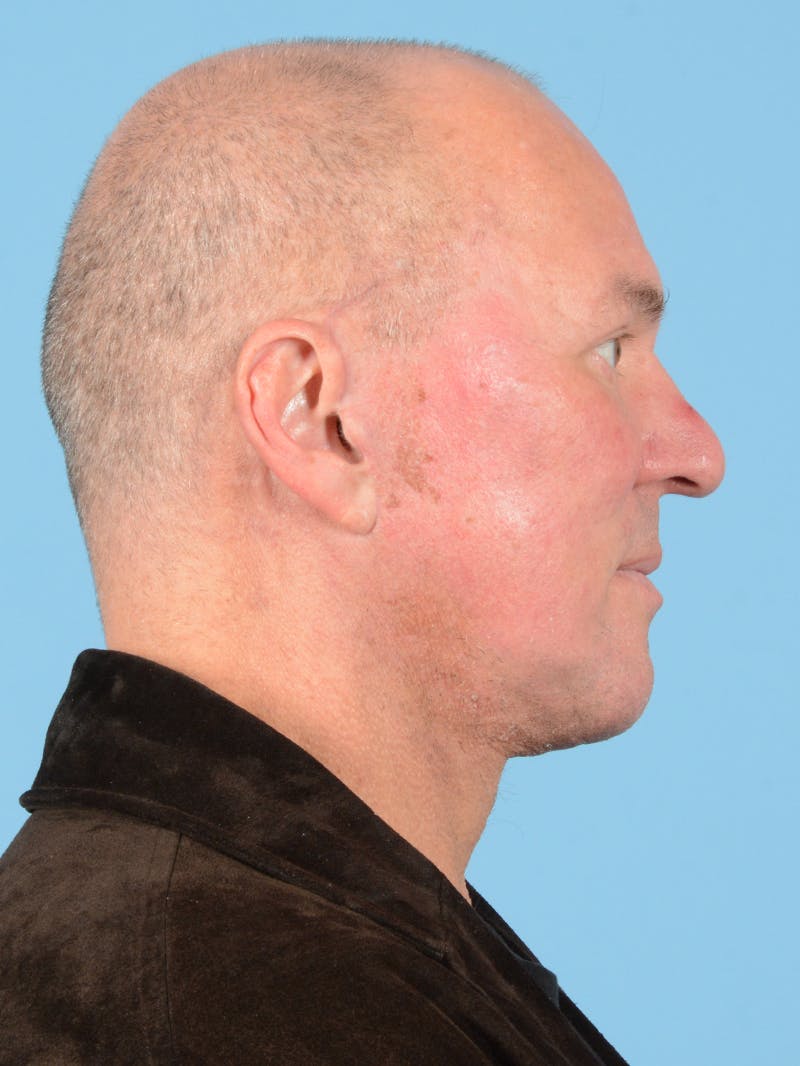 Facelift Before & After Gallery - Patient 113493042 - Image 6