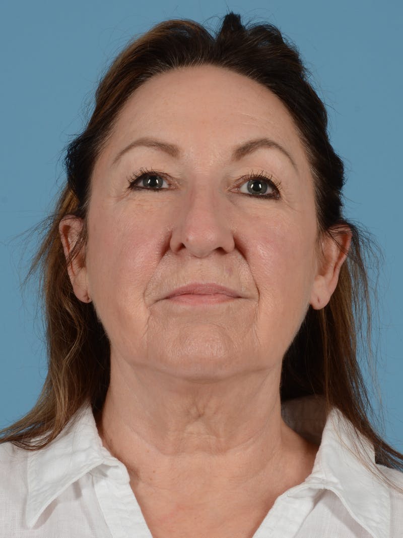 Facelift Before & After Gallery - Patient 113494856 - Image 1