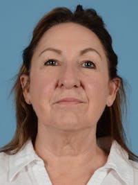 Facelift Before & After Gallery - Patient 113494856 - Image 1