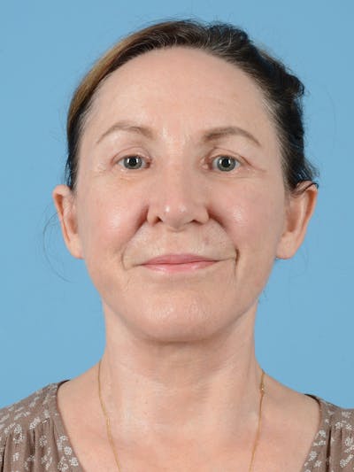 Facelift Before & After Gallery - Patient 113494856 - Image 2