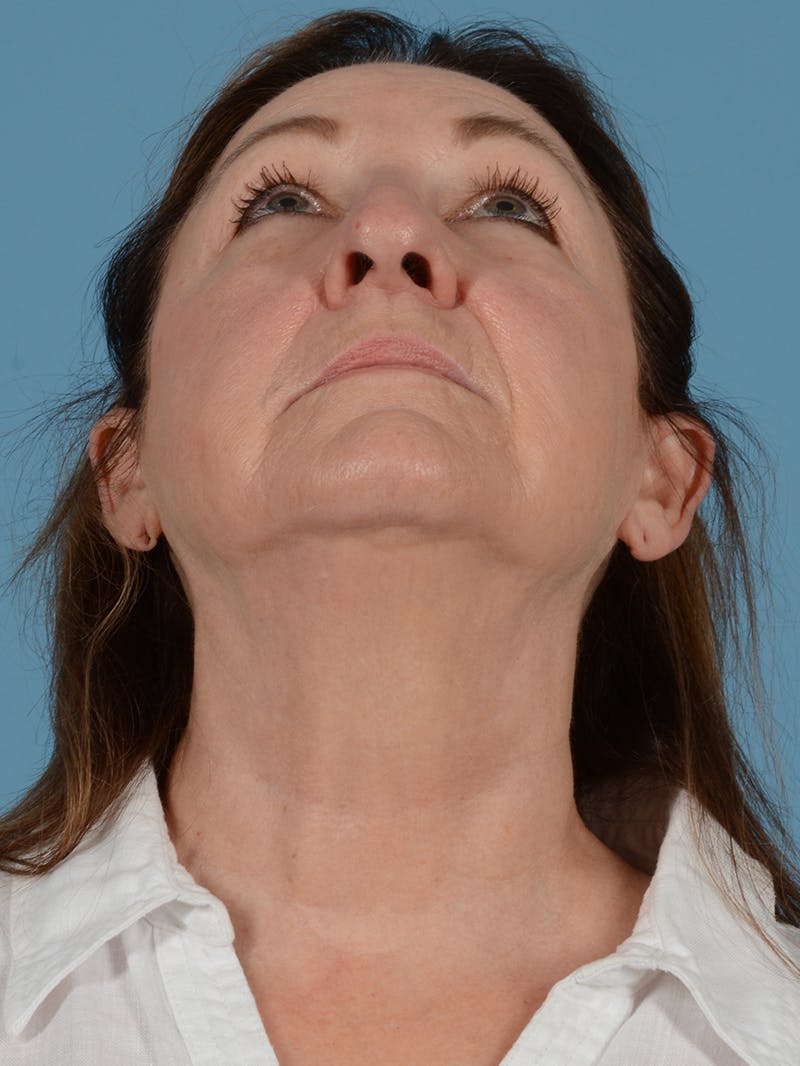 Facelift Before & After Gallery - Patient 113494856 - Image 3