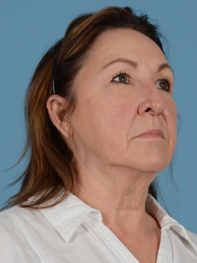 Neck Lift Before & After Gallery - Patient 113494826 - Image 5