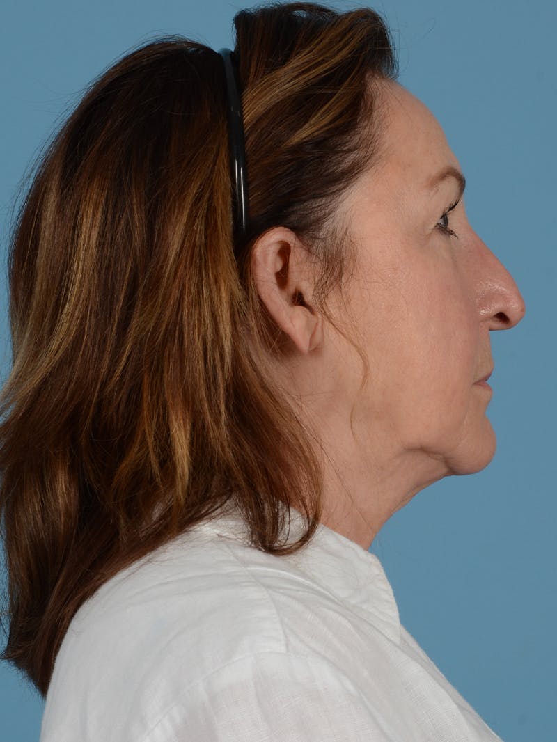 Facelift Before & After Gallery - Patient 113494856 - Image 7