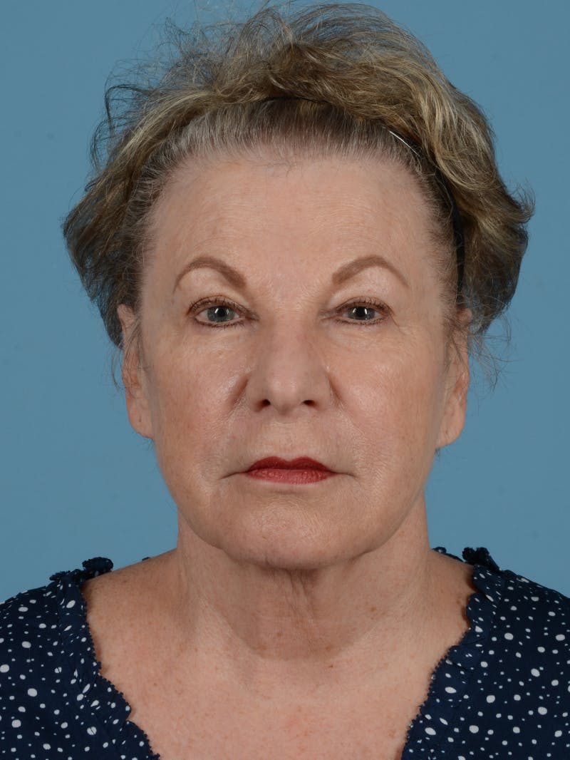 Facelift Before & After Gallery - Patient 113498324 - Image 1