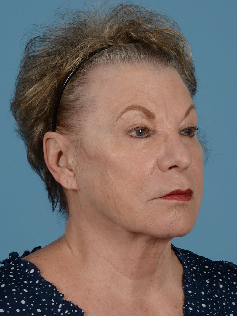 Facelift Before & After Gallery - Patient 113498324 - Image 3