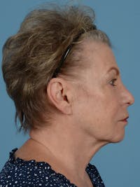 Rhinoplasty Before & After Gallery - Patient 113500026 - Image 1