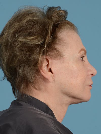 Neck Lift Before & After Gallery - Patient 113500037 - Image 6