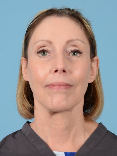Facelift Before & After Gallery - Patient 113503554 - Image 2