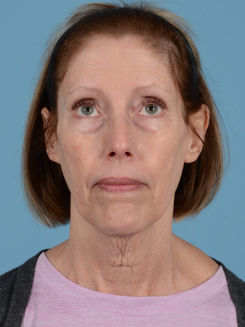 Facelift Before & After Gallery - Patient 113503554 - Image 3