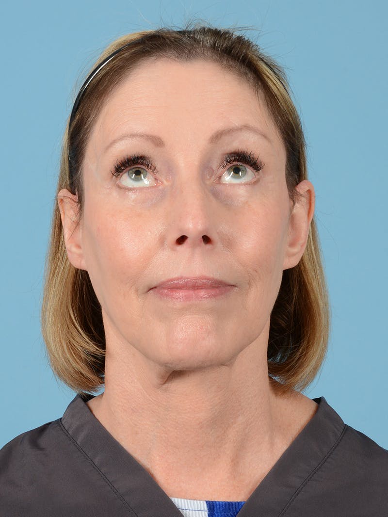 Facelift Before & After Gallery - Patient 113503554 - Image 4