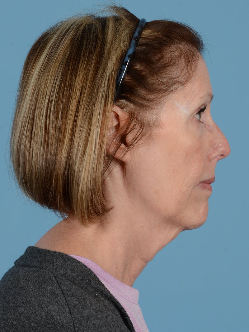 Facelift Before & After Gallery - Patient 113503554 - Image 7
